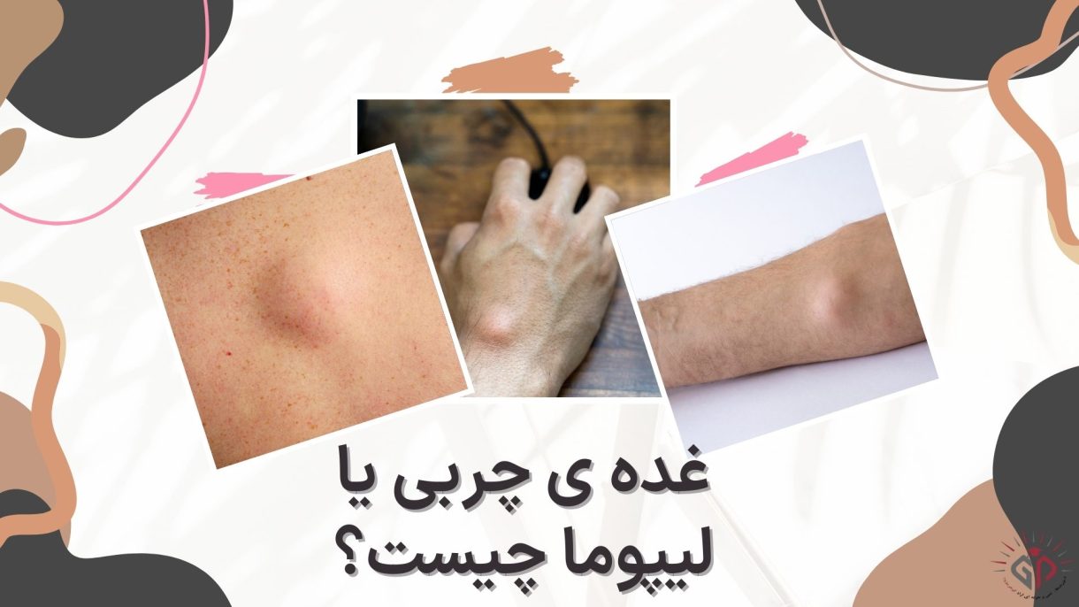 غده ی چربی یا لیپوما چیست؟
