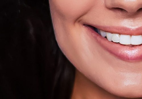 بوتاکس برای لبخند لثه‌ای