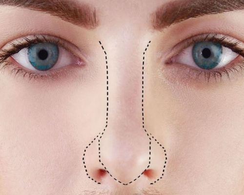 پلکسر بینی چیست؟