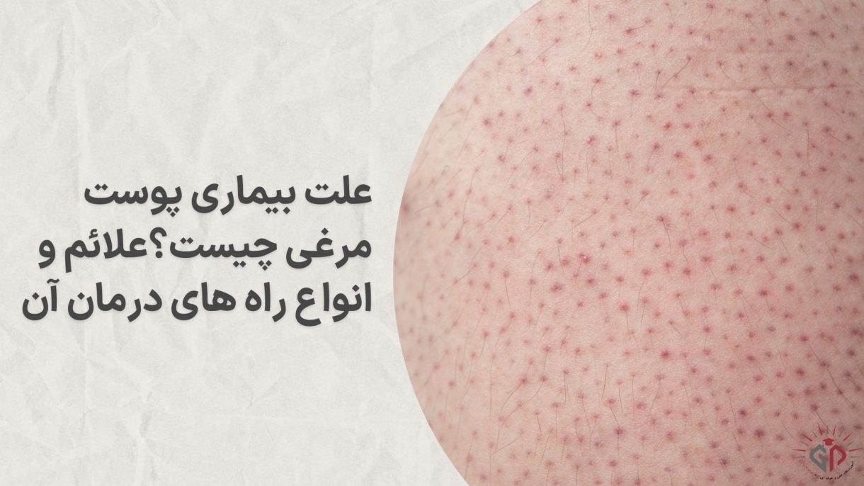 علت بیماری پوست مرغی چیست؟علائم و انواع راه های درمان آن