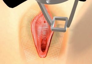 درمان تیرگی واژن با لیزر